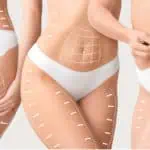 борба с целулит