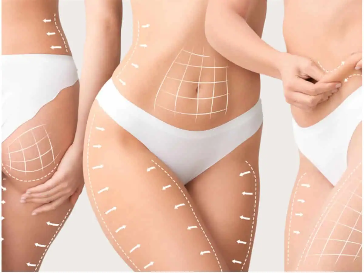 борба с целулит