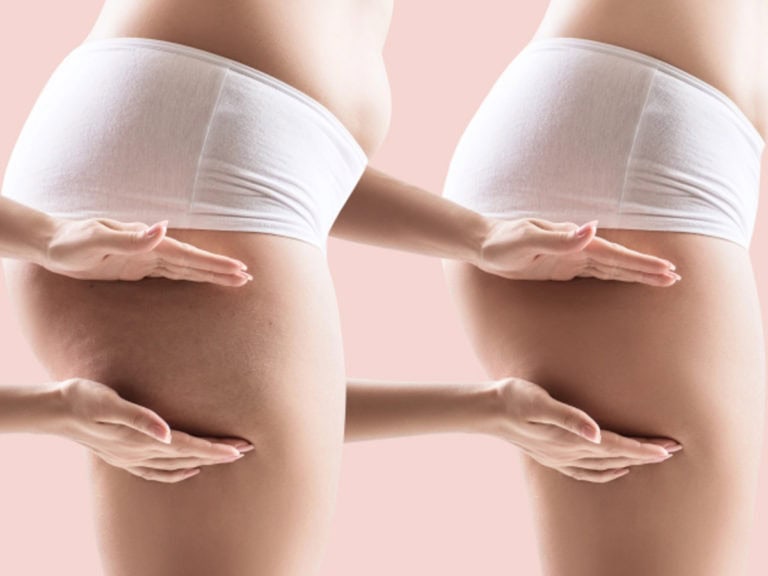 видове целулит