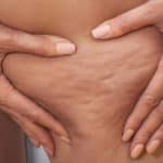 Възпаление и целулит